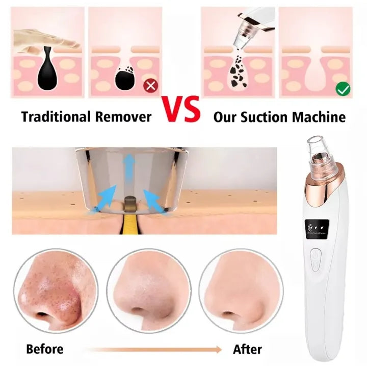 Blackhead Remover Pore Vacuum, Upgraded Electric Facial Pore Cleaner with 5 Suction Power & 5 Probes, 4 Pimple Popper Tools, USB Rechargeable Blackhead Vacuum Kit for Women & Men